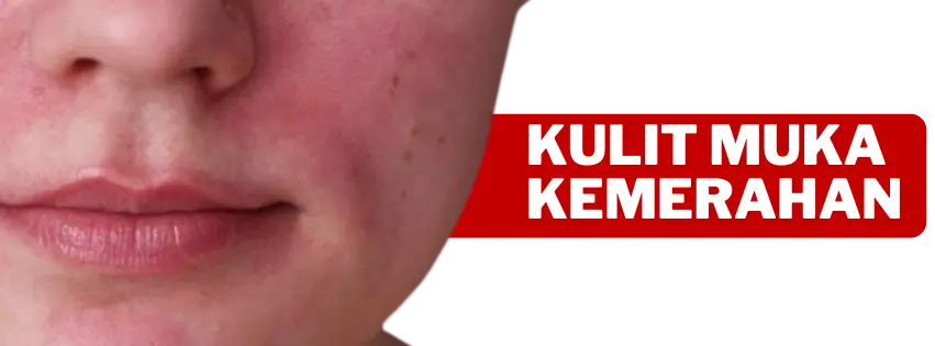 KULIT MUKA Kemerahan