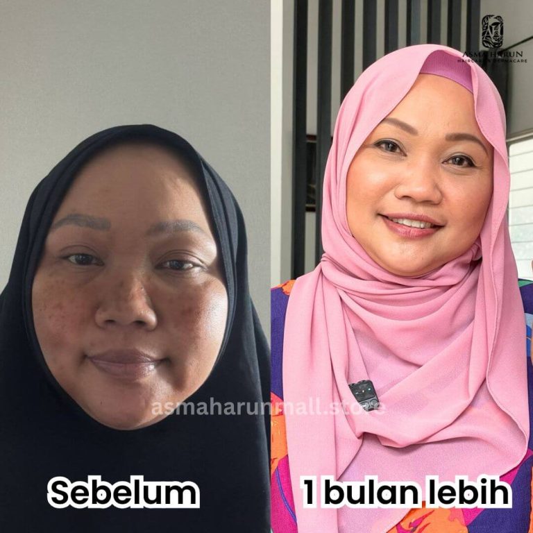 Kak Emma, 55 Tahun - Jeragat di pipi dah berkurang sejak guna produk ustazah. Kulit makin cerah dan glowing